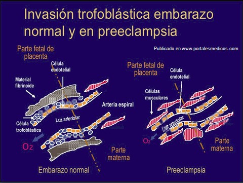 preeclamsia/invasion_trofoblastica_lecho_placentario_3 preeclamsia/invasion_trofoblastica_lecho_placentario_3